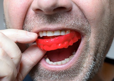 Closeup of man inserting mouthguard over upper arch