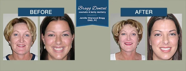 Woman smiling before and after treatment from Cumming dentists