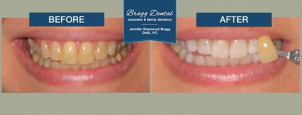 Close up of smile before and after teeth whitening