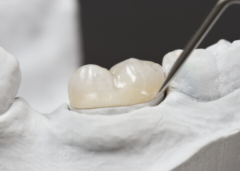 Dental crown covering a tooth in a model of the mouth