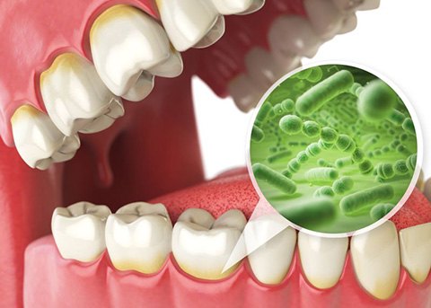 Illustration of harmful bacteria along the gumline