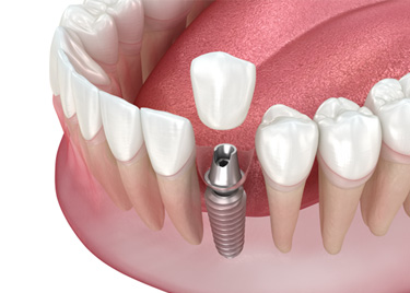Illustration of a single dental implant