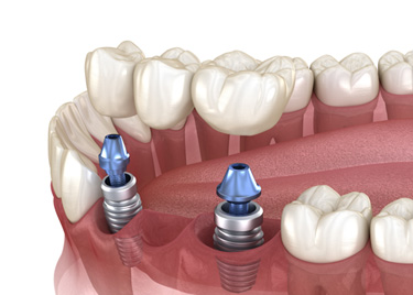 Illustration of an implant bridge