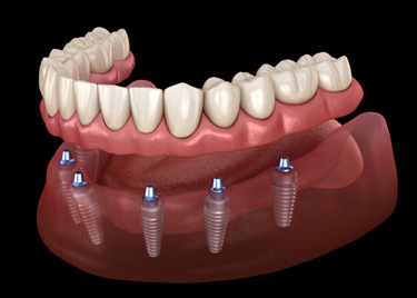 Illustration of an implant denture