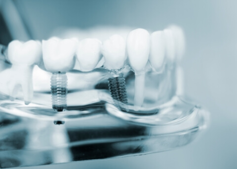 Two dental implants in a model of the mouth