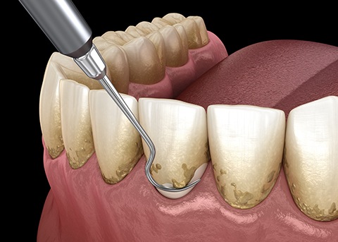 Scaling and root planing can help protect your teeth and gums from gum disease