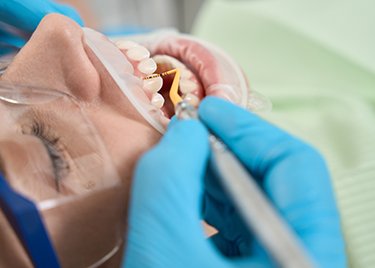 Scaling and root planing can be done in two appointments