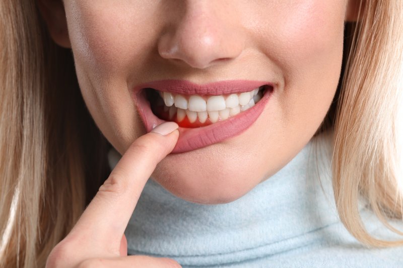 a woman showing signs of gum disease