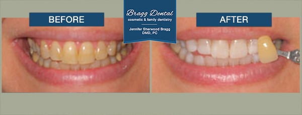 Comparison of yellow teeth to a bright white teeth