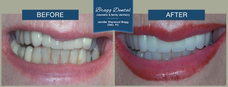 Before and After photos highlighting brighter, straighter teeth